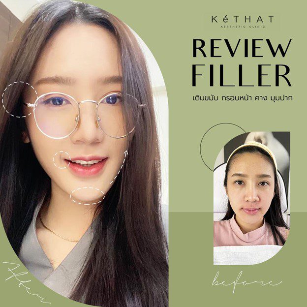Review Filler เติมขมับ ยกกระชับใบหน้า