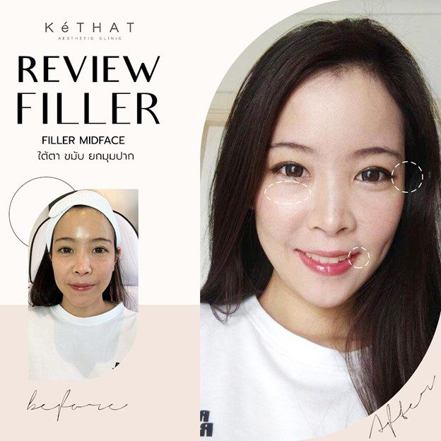 Review Filler ฉีดฟิลเลอร์ใต้ตา