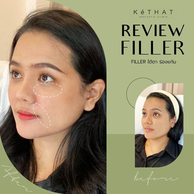 Review Filler ฉีดฟิลเลอร์ใต้ตา ร่องแก้ม