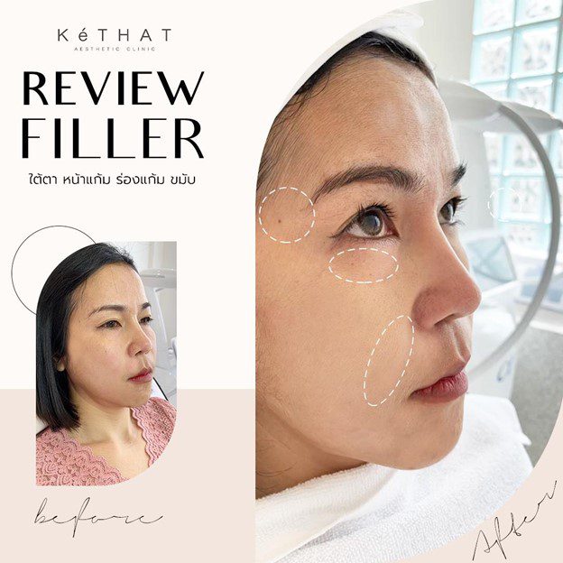Review Filler ยกกระชับหน้าแก้ม