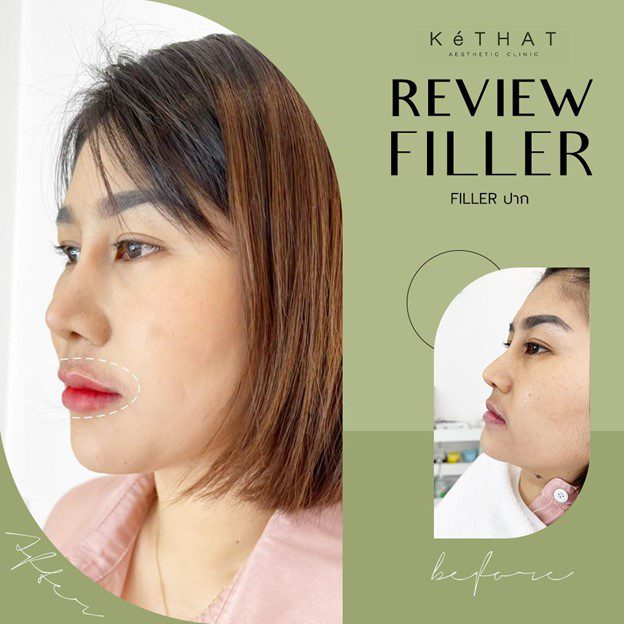 Review Filler ปาก