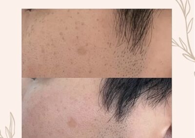 Laser กระฝ้า