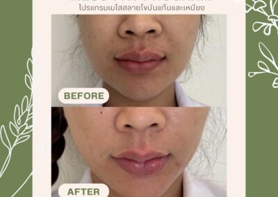 Meso Fat สลายไขมันบริเวณแก้มและเหนียง