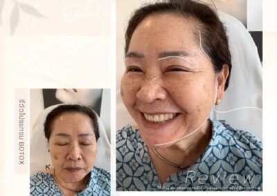 Botox ลดริ้วรอยอายุ