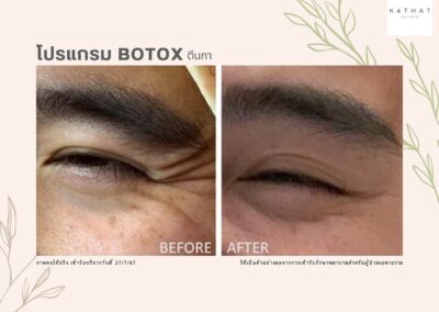 Botox ตีนกา
